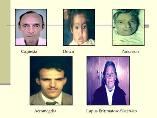 Caquexia Down Parkinson
Acromegalia Lupus Eritematoso Sistémico
 