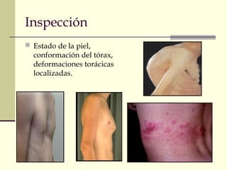 Inspección
 Estado de la piel,
conformación del tórax,
deformaciones torácicas
localizadas.
 