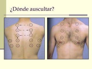 ¿Dónde auscultar?
 
