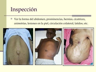 Inspección
 Ver la forma del abdomen, prominencias, hernias, cicatrices,
asimetrías, lesiones en la piel, circulación colateral, latidos, etc.
 