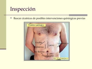 Inspección
 Buscar cicatrices de posibles intervenciones quirúrgicas previas
 