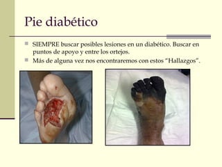 Pie diabético
 SIEMPRE buscar posibles lesiones en un diabético. Buscar en
puntos de apoyo y entre los ortejos.
 Más de alguna vez nos encontraremos con estos “Hallazgos”.
 