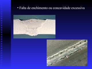 Falta de enchimento ou concavidade excessiva 