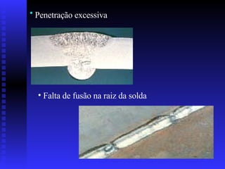Penetração excessiva   Falta de fusão na raiz da solda  