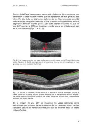 Dr. G. Vincent P. Cedilás Oftalmología
9
Dentro de la fóvea hay un mayor número de núcleos de fotorreceptores, por
esta razón la capa nuclear externa que los representa, es más gruesa a ese
nivel. Por otro lado, los segmentos externos de los fotorreceptores son más
más largos en la región foveal por lo que la banda correspondiente a estos
segmentos también es más gruesa. Otro dato a tener en cuenta es, que en
una OCT normal, la CFNR de la retina, es más gruesa en el lado nasal que
en el lado temporal (figs. 2.4 y 2.5).
Fig. 2.4. La imagen muestra una capa nuclear externa más gruesa a nivel foveal, flecha roja
doble. También la banda correspondiente al segmento externo de los receptores es más
gruesa a ese nivel, punta de flecha roja.
Fig. 2.5. En una OCT normal, el lado nasal de la mácula es fácil de reconocer, ya que la
CFNR, destacada en verde, es más gruesa, mientras que el lado temporal es más delgado.
Se puede observar la hialoides posterior del vítreo, destacada en color rojo y fuertemente
adherida a la región macular.
En la imagen de una OCT se visualizan los vasos retinianos como
estructuras que bloquean la transmisión de la luz. Aparecen como bandas
verticales oscuras de reflectividad reducida que se extiende hacia las capas
más profundas.
 
