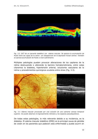 Dr. G. Vincent P. Cedilás Oftalmología
12
Fig. 3.2. OCT de un paciente diabético con edema macular. Se aprecia la acumulación de
fluido entre las capas de la retina con desaparición de la depresión foveal central. También
se aprecia acumulación de fluido a nivel subretinaino.
Múltiples patologías pueden provocar alteraciones de los capilares de la
retina destruyendo o alterando la barrera hematorretiniana, entre estas
citaremos la diabetes, hipertensión arterial, oclusiones vasculares de la
retina y procedimientos quirúrgicos oculares entre otras (Fig. 3.3).
Fig. 3.3. Edema macular provocado por una oclusión de una subrama venosa temporal
superior. Se puede observar el engrosamiento retiniano y los espacios pseudoquísticos.
De todas estas patologías, la más relevante debido a su incidencia, es la
diabetes. El edema macular diabético (EMD) es la principal causa de pérdida
de visión en los pacientes que padecen esta enfermedad y puede ocurrir en
 