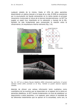 Dr. G. Vincent P. Cedilás Oftalmología
13
cualquier estadio de la misma. Hasta el 10% de estos pacientes
desarrollarán un edema macular a lo largo de su vida. El EMD se caracteriza
por la acumulación de líquido extracelular en la retina siendo el principal
mecanismo involucrado la rotura de la barrera hematorretiniana. La OCT ha
jugado un papel muy importante en la valoración y manejo de la RD,
también ha sido fundamental para comprender la relación entre la
vítreorretina y la arquitectura interna retiniana (Fig. 3.4).
Fig. 3.4. OCT de un Edema Macular Diabético (EMD) clínicamente significativo. El grosor
retiniano central (GRC) promedio es de 461µ. También se pueden observar espacios
cistoides.
Además de ofrecer una valiosa información tanto cualitativa como
cuantitativa de los eventos que se desarrollan en el espesor de la retina en
pacientes diabéticos, la OCT resulta fundamental a la hora de establecer un
seguimiento a estos pacientes, y en especial, para valorar el resultado de
los diferentes tratamientos que se aplican en la actualidad, como son, la
 