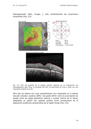 Dr. G. Vincent P. Cedilás Oftalmología
14
fotocoagulación láser, cirugía, y más recientemente las inyecciones
intravítreas (Fig. 3.5).
Fig. 3.5. OCT del paciente de la imagen anterior después de un tratamiento con
fotocoagulación láser focal. El promedio del GRC ha disminuido de 513µ a 326µ con una
importante mejoría en la AV.
Otro tipo de edema con unas características muy especiales es el edema
macular cistoide o quístico (EMC). Se puede definir como la acumulación de
líquido entre las capas plexiforme externa y nuclear interna de la retina,
adoptando un patrón con aspecto quístico como consecuencia de la
disposición anatómica característica de la región foveal (Fig. 3.6).
 