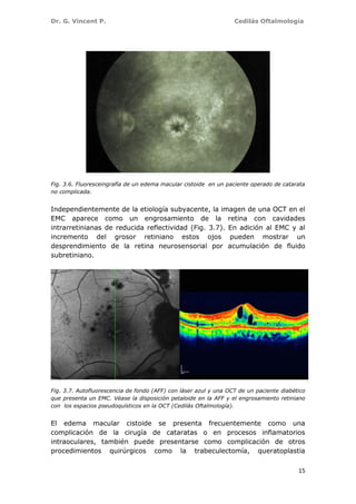 Dr. G. Vincent P. Cedilás Oftalmología
15
Fig. 3.6. Fluoresceingrafía de un edema macular cistoide en un paciente operado de catarata
no complicada.
Independientemente de la etiología subyacente, la imagen de una OCT en el
EMC aparece como un engrosamiento de la retina con cavidades
intrarretinianas de reducida reflectividad (Fig. 3.7). En adición al EMC y al
incremento del grosor retiniano estos ojos pueden mostrar un
desprendimiento de la retina neurosensorial por acumulación de fluido
subretiniano.
Fig. 3.7. Autofluorescencia de fondo (AFF) con láser azul y una OCT de un paciente diabético
que presenta un EMC. Véase la disposición petaloide en la AFF y el engrosamiento retiniano
con los espacios pseudoquísticos en la OCT (Cedilás Oftalmología).
El edema macular cistoide se presenta frecuentemente como una
complicación de la cirugía de cataratas o en procesos inflamatorios
intraoculares, también puede presentarse como complicación de otros
procedimientos quirúrgicos como la trabeculectomía, queratoplastia
 