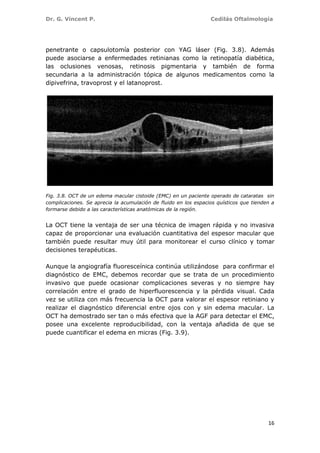 Dr. G. Vincent P. Cedilás Oftalmología
16
penetrante o capsulotomía posterior con YAG láser (Fig. 3.8). Además
puede asociarse a enfermedades retinianas como la retinopatía diabética,
las oclusiones venosas, retinosis pigmentaria y también de forma
secundaria a la administración tópica de algunos medicamentos como la
dipivefrina, travoprost y el latanoprost.
Fig. 3.8. OCT de un edema macular cistoide (EMC) en un paciente operado de cataratas sin
complicaciones. Se aprecia la acumulación de fluido en los espacios quísticos que tienden a
formarse debido a las características anatómicas de la región.
La OCT tiene la ventaja de ser una técnica de imagen rápida y no invasiva
capaz de proporcionar una evaluación cuantitativa del espesor macular que
también puede resultar muy útil para monitorear el curso clínico y tomar
decisiones terapéuticas.
Aunque la angiografía fluoresceínica continúa utilizándose para confirmar el
diagnóstico de EMC, debemos recordar que se trata de un procedimiento
invasivo que puede ocasionar complicaciones severas y no siempre hay
correlación entre el grado de hiperfluorescencia y la pérdida visual. Cada
vez se utiliza con más frecuencia la OCT para valorar el espesor retiniano y
realizar el diagnóstico diferencial entre ojos con y sin edema macular. La
OCT ha demostrado ser tan o más efectiva que la AGF para detectar el EMC,
posee una excelente reproducibilidad, con la ventaja añadida de que se
puede cuantificar el edema en micras (Fig. 3.9).
 