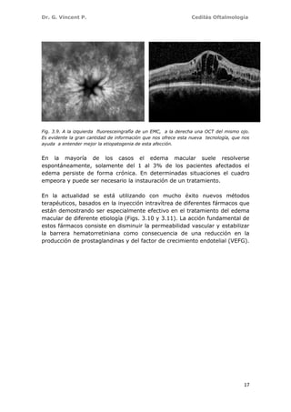 Dr. G. Vincent P. Cedilás Oftalmología
17
Fig. 3.9. A la izquierda fluoresceingrafía de un EMC, a la derecha una OCT del mismo ojo.
Es evidente la gran cantidad de información que nos ofrece esta nueva tecnología, que nos
ayuda a entender mejor la etiopatogenia de esta afección.
En la mayoría de los casos el edema macular suele resolverse
espontáneamente, solamente del 1 al 3% de los pacientes afectados el
edema persiste de forma crónica. En determinadas situaciones el cuadro
empeora y puede ser necesario la instauración de un tratamiento.
En la actualidad se está utilizando con mucho éxito nuevos métodos
terapéuticos, basados en la inyección intravítrea de diferentes fármacos que
están demostrando ser especialmente efectivo en el tratamiento del edema
macular de diferente etiología (Figs. 3.10 y 3.11). La acción fundamental de
estos fármacos consiste en disminuir la permeabilidad vascular y estabilizar
la barrera hematorretiniana como consecuencia de una reducción en la
producción de prostaglandinas y del factor de crecimiento endotelial (VEFG).
 