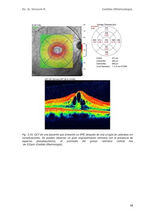 Dr. G. Vincent P. Cedilás Oftalmología
18
Fig. 3.10. OCT de una paciente que presentó un EMC después de una cirugía de cataratas sin
complicaciones. Se pueden observar un gran engrosamiento retiniano con la presencia de
espacios pseudoquísticos, el promedio del grosor retiniano central fue
de 533µm (Cedilás Oftalmología).
 