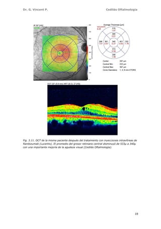Dr. G. Vincent P. Cedilás Oftalmología
19
Fig. 3.11. OCT de la misma paciente después del tratamiento con inyecciones intravítreas de
Ranibizumab (Lucentis). El promedio del grosor retiniano central disminuyó de 533µ a 340µ
con una importante mejoría de la agudeza visual (Cedilás Oftalmología).
 