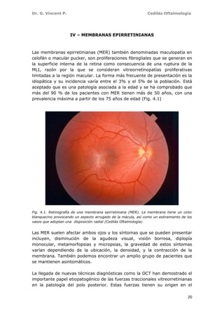 Dr. G. Vincent P. Cedilás Oftalmología
20
IV – MEMBRANAS EPIRRETINIANAS
Las membranas epirretinianas (MER) también denominadas maculopatía en
celofán o macular pucker, son proliferaciones fibrogliales que se generan en
la superficie interna de la retina como consecuencia de una ruptura de la
MLI, razón por la que se consideran vitreorretinopatías proliferativas
limitadas a la región macular. La forma más frecuente de presentación es la
idiopática y su incidencia varía entre el 3% y el 5% de la población. Está
aceptado que es una patología asociada a la edad y se ha comprobado que
más del 90 % de los pacientes con MER tienen más de 50 años, con una
prevalencia máxima a partir de los 75 años de edad (Fig. 4.1)
Fig. 4.1. Retinografía de una membrana epirretiniana (MER). La membrana tiene un color
blanquecino provocando un aspecto arrugado de la mácula, así como un estiramiento de los
vasos que adoptan una disposición radial (Cedilás Oftalmología).
Las MER suelen afectar ambos ojos y los síntomas que se pueden presentar
incluyen, disminución de la agudeza visual, visión borrosa, diplopía
monocular, metamorfopsias y micropsias, la gravedad de estos síntomas
varían dependiendo de la ubicación, la densidad, y la contracción de la
membrana. También podemos encontrar un amplio grupo de pacientes que
se mantienen asintomáticos.
La llegada de nuevas técnicas diagnósticas como la OCT han demostrado el
importante papel etiopatogénico de las fuerzas traccionales vitreorretinianas
en la patología del polo posterior. Estas fuerzas tienen su origen en el
 
