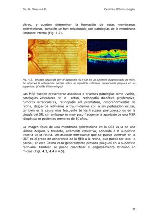 Dr. G. Vincent P. Cedilás Oftalmología
21
vítreo, y pueden determinar la formación de estas membranas
epirretinianas, también se han relacionado con patologías de la membrana
limitante interna (Fig. 4.2).
Fig. 4.2. Imagen adquirida con el Spectralis OCT-SD en un paciente diagnosticado de MER.
Se observa la adherencia parcial sobre la superficie retiniana provocando pliegues en su
superficie. (Cedilás Oftalmología).
Las MER pueden presentarse asociadas a diversas patologías como uveítis,
patologías vasculares de la retina, retinopatía diabética proliferativa,
tumores intraoculares, retinopatía del prematuro, desprendimientos de
retina, desgarros retinianos o traumatismos con o sin perforación ocular,
también es la causa más frecuente de los fracasos postoperatorios en la
cirugía del DR, sin embargo es muy poco frecuente la aparición de una MER
idiopática en pacientes menores de 50 años.
La imagen típica de una membrana epirretiniana en la OCT es la de una
lámina delgada y brillante, altamente reflectiva, adherida a la superficie
interna de la retina. Un aspecto interesante que se puede observar en la
OCT es el grado de adherencia de la MER a la retina, que puede ser total o
parcial, en este último caso generalmente provoca pliegues en la superficie
retiniana. También se puede cuantificar el engrosamiento retiniano en
micras (Figs. 4.3, 4.4 y 4.5).
 