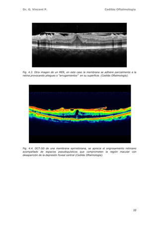 Dr. G. Vincent P. Cedilás Oftalmología
22
Fig. 4.3. Otra imagen de un MER, en este caso la membrana se adhiere parcialmente a la
retina provocando pliegues o “arrugamientos” en su superficie. (Cedilás Oftalmología).
Fig. 4.4. OCT-SD de una membrana epirretiniana, se aprecia el engrosamiento retiniano
acompañado de espacios pseudoquísticos que comprometen la región macular con
desaparición de la depresión foveal central (Cedilás Oftalmología).
 