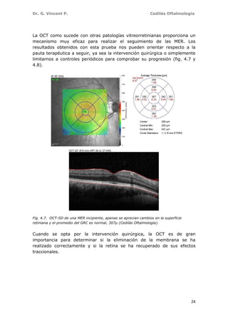 Dr. G. Vincent P. Cedilás Oftalmología
24
La OCT como sucede con otras patologías vitreorretinianas proporciona un
mecanismo muy eficaz para realizar el seguimiento de las MER. Los
resultados obtenidos con esta prueba nos pueden orientar respecto a la
pauta terapéutica a seguir, ya sea la intervención quirúrgica o simplemente
limitarnos a controles periódicos para comprobar su progresión (fig. 4.7 y
4.8).
Fig. 4.7. OCT-SD de una MER incipiente, apenas se aprecian cambios en la superficie
retiniana y el promedio del GRC es normal, 307µ (Cedilás Oftalmología).
Cuando se opta por la intervención quirúrgica, la OCT es de gran
importancia para determinar si la eliminación de la membrana se ha
realizado correctamente y si la retina se ha recuperado de sus efectos
traccionales.
 