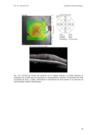 Dr. G. Vincent P. Cedilás Oftalmología
25
Fig. 4.8. OCT-SD de control del paciente de la imagen anterior, se puede observar la
progresión de la MER que ha provocado un engrosamiento retiniano. El promedio del GRC
ha pasado de 307µ a 378µ, confirmando la importancia de esta prueba en la evolución de
esta patología (Cedilás Oftalmología).
 