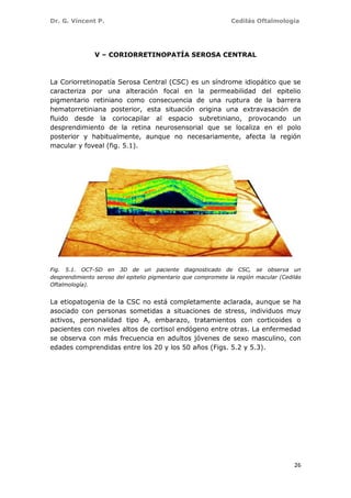 Dr. G. Vincent P. Cedilás Oftalmología
26
V – CORIORRETINOPATÍA SEROSA CENTRAL
La Coriorretinopatía Serosa Central (CSC) es un síndrome idiopático que se
caracteriza por una alteración focal en la permeabilidad del epitelio
pigmentario retiniano como consecuencia de una ruptura de la barrera
hematorretiniana posterior, esta situación origina una extravasación de
fluido desde la coriocapilar al espacio subretiniano, provocando un
desprendimiento de la retina neurosensorial que se localiza en el polo
posterior y habitualmente, aunque no necesariamente, afecta la región
macular y foveal (fig. 5.1).
Fig. 5.1. OCT-SD en 3D de un paciente diagnosticado de CSC, se observa un
desprendimiento seroso del epitelio pigmentario que compromete la región macular (Cedilás
Oftalmología).
La etiopatogenia de la CSC no está completamente aclarada, aunque se ha
asociado con personas sometidas a situaciones de stress, individuos muy
activos, personalidad tipo A, embarazo, tratamientos con corticoides o
pacientes con niveles altos de cortisol endógeno entre otras. La enfermedad
se observa con más frecuencia en adultos jóvenes de sexo masculino, con
edades comprendidas entre los 20 y los 50 años (Figs. 5.2 y 5.3).
 