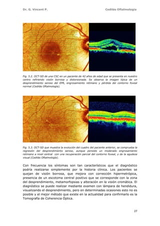 Dr. G. Vincent P. Cedilás Oftalmología
27
Fig. 5.2. OCT-SD de una CSC en un paciente de 42 años de edad que se presenta en nuestro
centro refiriendo visión borrosa y distorsionada. Se observa la imagen típica de un
desprendimiento seroso del EPR, engrosamiento retiniano y pérdida del contorno foveal
normal (Cedilás Oftalmología).
Fig. 5.3. OCT-SD que muestra la evolución del cuadro del paciente anterior, se comprueba la
regresión del desprendimiento seroso, aunque persiste un moderado engrosamiento
retiniano a nivel central con una recuperación parcial del contorno foveal, y de la agudeza
visual (Cedilás Oftalmología).
Con frecuencia los síntomas son tan característicos que el diagnóstico
podría realizarse simplemente por la historia clínica. Los pacientes se
quejan de visión borrosa, que mejora con corrección hipermetrópica,
presencia de un escotoma central positivo que se corresponde con la zona
del desprendimiento, metamorfopsias y alteración en la visión cromática. El
diagnóstico se puede realizar mediante examen con lámpara de hendidura,
visualizando el desprendimiento, pero en determinadas ocasiones esto no es
posible y el mejor método que existe en la actualidad para confirmarlo es la
Tomografía de Coherencia Óptica.
 