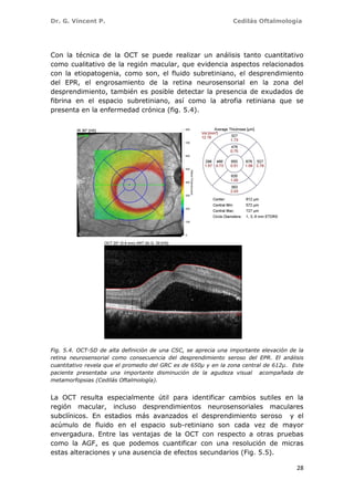 Dr. G. Vincent P. Cedilás Oftalmología
28
Con la técnica de la OCT se puede realizar un análisis tanto cuantitativo
como cualitativo de la región macular, que evidencia aspectos relacionados
con la etiopatogenia, como son, el fluido subretiniano, el desprendimiento
del EPR, el engrosamiento de la retina neurosensorial en la zona del
desprendimiento, también es posible detectar la presencia de exudados de
fibrina en el espacio subretiniano, así como la atrofia retiniana que se
presenta en la enfermedad crónica (fig. 5.4).
Fig. 5.4. OCT-SD de alta definición de una CSC, se aprecia una importante elevación de la
retina neurosensorial como consecuencia del desprendimiento seroso del EPR. El análisis
cuantitativo revela que el promedio del GRC es de 650µ y en la zona central de 612µ. Este
paciente presentaba una importante disminución de la agudeza visual acompañada de
metamorfopsias (Cedilás Oftalmología).
La OCT resulta especialmente útil para identificar cambios sutiles en la
región macular, incluso desprendimientos neurosensoriales maculares
subclínicos. En estadios más avanzados el desprendimiento seroso y el
acúmulo de fluido en el espacio sub-retiniano son cada vez de mayor
envergadura. Entre las ventajas de la OCT con respecto a otras pruebas
como la AGF, es que podemos cuantificar con una resolución de micras
estas alteraciones y una ausencia de efectos secundarios (Fig. 5.5).
 