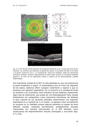 Dr. G. Vincent P. Cedilás Oftalmología
30
Fig. 5.6. OCT-SD del mismo paciente de las figuras anteriores a los 3 meses del inicio de los
síntomas. Se confirma una resolución completa del cuadro, el promedio del GRC es de 265µ
y el grosor central de 213 µ. La recuperación visual fue completa, todas las estructuras
retinianas resultaron intactas, especialmente la capa nuclear externa, la membrana limitante
externa y la unión de los segmentos interno y externo de los fotorreceptores (Cedilás
Oftalmología).
Una importante ventaja de la OCT en esta patología es, que nos proporciona
la pauta terapéutica a seguir. Si comprobamos que se inicia una regresión
de los signos, debemos diferir cualquier tratamiento y esperar a que se
produzca una regresión espontánea. Por el contrario si la cantidad de fluido
se mantiene o se incrementa, sería indicativo de que debemos implementar
algún tipo de tratamiento, que puede ser una fotocoagulación focal, terapia
fotodinámica con verteporfino o bien inyecciones intravítreas. No obstante
la gran mayoría de los pacientes afectados experimentan una regresión
espontánea en un período de 3 a 6 meses. La agudeza visual normalmente
se recupera en su totalidad aunque algunos pacientes se quejan de leves
defectos visuales residuales permanentes, probablemente secuelas
relacionadas con cambios estructurales en el EPR afectado, como
consecuencia del desprendimiento macular prolongado y recurrente (figs.
5.7 y 5.8).
 