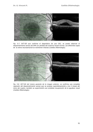 Dr. G. Vincent P. Cedilás Oftalmología
31
Fig. 5.7. OCT-SD que confirma el diagnóstico de una CSC, se puede observar el
desprendimiento seroso del EPR con pérdida del contorno foveal normal. Las diferentes capas
de la retina neurosensorial se mantienen intactas (Cedilás Oftalmología).
Fig. 5.8. OCT-SD del mismo paciente de la imagen anterior, se confirma una completa
regresión del desprendimiento seroso que se produjo espontáneamente a los 4 meses del
inicio del cuadro, también se experimentó una completa recuperación de la agudeza visual
(Cedilás Oftalmología).
 