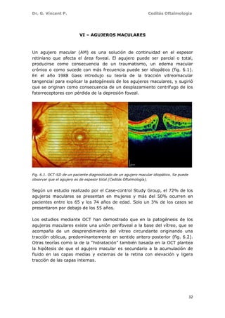 Dr. G. Vincent P. Cedilás Oftalmología
32
VI – AGUJEROS MACULARES
Un agujero macular (AM) es una solución de continuidad en el espesor
retiniano que afecta el área foveal. El agujero puede ser parcial o total,
producirse como consecuencia de un traumatismo, un edema macular
crónico o como sucede con más frecuencia puede ser idiopático (fig. 6.1).
En el año 1988 Gass introdujo su teoría de la tracción vitreomacular
tangencial para explicar la patogénesis de los agujeros maculares, y sugirió
que se originan como consecuencia de un desplazamiento centrífugo de los
fotorreceptores con pérdida de la depresión foveal.
Fig. 6.1. OCT-SD de un paciente diagnosticado de un agujero macular idiopático. Se puede
observar que el agujero es de espesor total (Cedilás Oftalmología).
Según un estudio realizado por el Case-control Study Group, el 72% de los
agujeros maculares se presentan en mujeres y más del 50% ocurren en
pacientes entre los 65 y los 74 años de edad. Solo un 3% de los casos se
presentaron por debajo de los 55 años.
Los estudios mediante OCT han demostrado que en la patogénesis de los
agujeros maculares existe una unión perifoveal a la base del vítreo, que se
acompaña de un desprendimiento del vítreo circundante originando una
tracción oblicua, predominantemente en sentido antero-posterior (fig. 6.2).
Otras teorías como la de la “hidratación” también basada en la OCT plantea
la hipótesis de que el agujero macular es secundario a la acumulación de
fluido en las capas medias y externas de la retina con elevación y ligera
tracción de las capas internas.
 