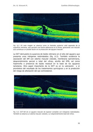 Dr. G. Vincent P. Cedilás Oftalmología
33
Fig. 6.2. En esta imagen se observa como la hialoides posterior está separada de la
superficie retiniana, solo persiste una fuerte adherencia en la fóvea, generando una tracción
que constituye un posible factor en la producción del agujero macular.
La OCT demuestra la ausencia de tejido retiniano en el sitio del agujero que
presenta unos márgenes redondeados (fig. 6.3). También evidencia la
asociación del AM con edema macular cistoide, membrana epirretiniana,
desprendimiento parcial o total del vítreo, atrofia del EPR, así como
hipertrofia o presencia de tejido residual en la base de los agujeros
lamelares. Otro papel importante de la OCT es en la valoración y el
pronóstico del resultado de los tratamientos quirúrgicos y en la predicción
del riesgo de afectación del ojo contralateral.
Fig. 6.3. OCT-SD de un agujero macular de espesor completo con márgenes redondeados.
También se observa un edema macular cistoide y un desprendimiento total del vítreo.
 