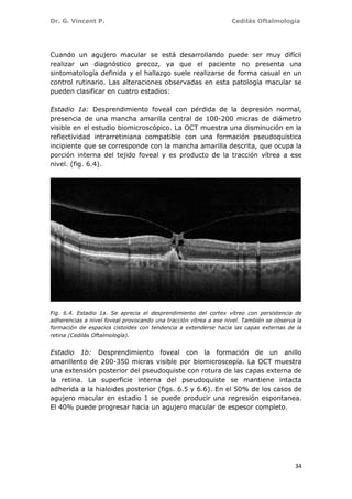 Dr. G. Vincent P. Cedilás Oftalmología
34
Cuando un agujero macular se está desarrollando puede ser muy difícil
realizar un diagnóstico precoz, ya que el paciente no presenta una
sintomatología definida y el hallazgo suele realizarse de forma casual en un
control rutinario. Las alteraciones observadas en esta patología macular se
pueden clasificar en cuatro estadios:
Estadio 1a: Desprendimiento foveal con pérdida de la depresión normal,
presencia de una mancha amarilla central de 100-200 micras de diámetro
visible en el estudio biomicroscópico. La OCT muestra una disminución en la
reflectividad intrarretiniana compatible con una formación pseudoquística
incipiente que se corresponde con la mancha amarilla descrita, que ocupa la
porción interna del tejido foveal y es producto de la tracción vítrea a ese
nivel. (fig. 6.4).
Fig. 6.4. Estadio 1a. Se aprecia el desprendimiento del cortex vítreo con persistencia de
adherencias a nivel foveal provocando una tracción vítrea a ese nivel. También se observa la
formación de espacios cistoides con tendencia a extenderse hacia las capas externas de la
retina (Cedilás Oftalmología).
Estadio 1b: Desprendimiento foveal con la formación de un anillo
amarillento de 200-350 micras visible por biomicroscopía. La OCT muestra
una extensión posterior del pseudoquiste con rotura de las capas externa de
la retina. La superficie interna del pseudoquiste se mantiene intacta
adherida a la hialoides posterior (figs. 6.5 y 6.6). En el 50% de los casos de
agujero macular en estadio 1 se puede producir una regresión espontanea.
El 40% puede progresar hacia un agujero macular de espesor completo.
 