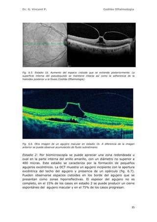 Dr. G. Vincent P. Cedilás Oftalmología
35
Fig. 6.5. Estadio 1b. Aumento del espacio cistoide que se extiende posteriormente. La
superficie interna del pseudoquiste se mantiene intacta así como la adherencia de la
hialoides posterior a la fóvea (Cedilás Oftalmología).
Fig. 6.6. Otra imagen de un agujero macular en estadio 1b. A diferencia de la imagen
anterior se puede observar acumulación de fluido subretiniano.
Estadio 2: Por biomicroscopía se puede apreciar una zona redondeada u
oval en la parte interna del anillo amarillo, con un diámetro no superior a
400 micras. Este estadio se caracteriza por la formación de pequeños
agujeros excéntricos. La OCT muestra un agujero incipiente con la apertura
excéntrica del techo del agujero y presencia de un opérculo (fig. 6.7).
Pueden observarse espacios cistoides en los borde del agujero que se
presentan como zonas hiporreflectivas. El espesor del agujero no es
completo, en el 15% de los casos en estadio 2 se puede producir un cierre
espontáneo del agujero macular y en el 75% de los casos progresan.
 
