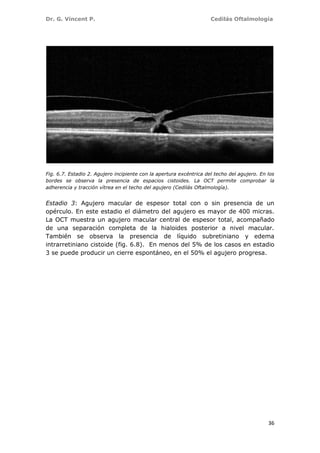 Dr. G. Vincent P. Cedilás Oftalmología
36
Fig. 6.7. Estadio 2. Agujero incipiente con la apertura excéntrica del techo del agujero. En los
bordes se observa la presencia de espacios cistoides. La OCT permite comprobar la
adherencia y tracción vítrea en el techo del agujero (Cedilás Oftalmología).
Estadio 3: Agujero macular de espesor total con o sin presencia de un
opérculo. En este estadio el diámetro del agujero es mayor de 400 micras.
La OCT muestra un agujero macular central de espesor total, acompañado
de una separación completa de la hialoides posterior a nivel macular.
También se observa la presencia de líquido subretiniano y edema
intrarretiniano cistoide (fig. 6.8). En menos del 5% de los casos en estadio
3 se puede producir un cierre espontáneo, en el 50% el agujero progresa.
 