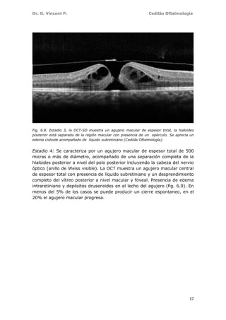 Dr. G. Vincent P. Cedilás Oftalmología
37
Fig. 6.8. Estadio 3, la OCT-SD muestra un agujero macular de espesor total, la hialoides
posterior está separada de la región macular con presencia de un opérculo. Se aprecia un
edema cistoide acompañado de líquido subretiniano (Cedilás Oftalmología).
Estadio 4: Se caracteriza por un agujero macular de espesor total de 500
micras o más de diámetro, acompañado de una separación completa de la
hialoides posterior a nivel del polo posterior incluyendo la cabeza del nervio
óptico (anillo de Weiss visible). La OCT muestra un agujero macular central
de espesor total con presencia de líquido subretiniano y un desprendimiento
completo del vítreo posterior a nivel macular y foveal. Presencia de edema
intraretiniano y depósitos drusenoides en el lecho del agujero (fig. 6.9). En
menos del 5% de los casos se puede producir un cierre espontaneo, en el
20% el agujero macular progresa.
 