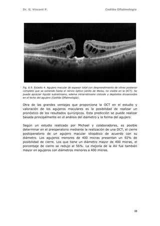 Dr. G. Vincent P. Cedilás Oftalmología
38
Fig. 6.9. Estadio 4. Agujero macular de espesor total con desprendimiento de vítreo posterior
completo que se extiende hasta el nervio óptico (anillo de Weiss, no visible en la OCT). Se
puede apreciar líquido subretiniano, edema intrarretiniano cistoide y depósitos drusenoides
en el lecho del agujero (Cedilás Oftalmología).
Otra de las grandes ventajas que proporciona la OCT en el estudio y
valoración de los agujeros maculares es la posibilidad de realizar un
pronóstico de los resultados quirúrgicos. Esta predicción se puede realizar
basada principalmente en el análisis del diámetro y la forma del agujero
Según un estudio realizado por Michael y colaboradores, es posible
determinar en el preoperatorio mediante la realización de una OCT, el cierre
postoperatorio de un agujero macular idiopático de acuerdo con su
diámetro. Los agujeros menores de 400 micras presentan un 92% de
posibilidad de cierre. Los que tiene un diámetro mayor de 400 micras, el
porcentaje de cierre se redujo al 56%. La mejoría de la AV fue también
mayor en agujeros con diámetros menores a 400 micras.
 