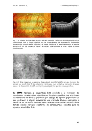 Dr. G. Vincent P. Cedilás Oftalmología
42
Fig. 7.4. Imagen de una DMAE atrófica en fase terminal. Destaca la atrofia geográfica que
compromete toda la región macular. El EPR prácticamente ha desaparecido pudiéndose
visualizar los grandes vasos coroideos. Se puede comprobar el adelgazamiento y la pérdida
estructural de las diferentes capas retinianas especialmente a nivel foveal (Cedilás
Oftalmología).
Fig. 7.5. Otra imagen de un paciente diagnosticado de DMAE atrófica en fase terminal. Se
aprecia una atrofia total de las estructuras retinianas a nivel central. La atenuación de estas
capas y la desaparición del EPR permiten la visualización los grandes vasos coroideos.
La DMAE húmeda o exudativa: Está asociada a la formación de
membranas neovasculares subretinianas de origen coroideo, que atraviesan
la membrana de Bruch y proliferan por debajo del epitelio pigmentario al
que destruyen o alteran provocando una marcada difusión plasmática o
hemática. La evolución de estas membranas termina con la formación de la
temida cicatriz fibroglial disciforme de consecuencias nefastas para la
agudeza visual (Fig. 7.6).
 
