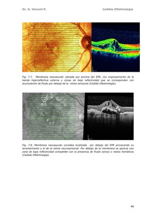 Dr. G. Vincent P. Cedilás Oftalmología
44
Fig. 7.7. Membrana neovascular ubicada por encima del EPR, con engrosamiento de la
banda hiperreflectiva externa y zonas de baja reflectividad que se corresponden con
acumulación de fluido por debajo de la retina sensorial (Cedilás Oftalmología).
Fig. 7.8. Membrana neovascular coroidea localizada por debajo del EPR provocando su
levantamiento y el de la retina neurosensorial. Por debajo de la membrana se aprecia una
zona de baja reflectividad compatible con la presencia de fluido seroso o restos hemáticos
(Cedilás Oftalmología).
 