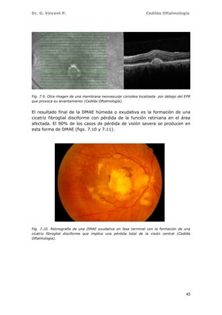 Dr. G. Vincent P. Cedilás Oftalmología
45
Fig. 7.9. Otra imagen de una membrana neovascular coroidea localizada por debajo del EPR
que provoca su levantamiento (Cedilás Oftalmología).
El resultado final de la DMAE húmeda o exudativa es la formación de una
cicatriz fibroglial disciforme con pérdida de la función retiniana en el área
afectada. El 90% de los casos de pérdida de visión severa se producen en
esta forma de DMAE (figs. 7.10 y 7.11).
Fig. 7.10. Retinografía de una DMAE exudativa en fase terminal con la formación de una
cicatriz fibroglial disciforme que implica una pérdida total de la visión central (Cedilás
Oftalmología).
 