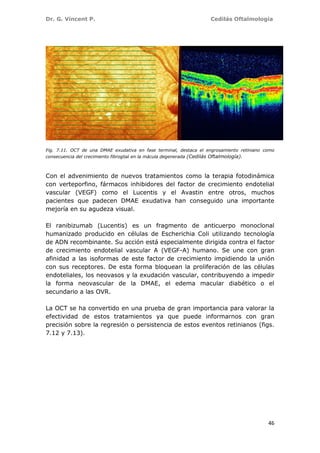 Dr. G. Vincent P. Cedilás Oftalmología
46
Fig. 7.11. OCT de una DMAE exudativa en fase terminal, destaca el engrosamiento retiniano como
consecuencia del crecimiento fibroglial en la mácula degenerada (Cedilás Oftalmología).
Con el advenimiento de nuevos tratamientos como la terapia fotodinámica
con verteporfino, fármacos inhibidores del factor de crecimiento endotelial
vascular (VEGF) como el Lucentis y el Avastin entre otros, muchos
pacientes que padecen DMAE exudativa han conseguido una importante
mejoría en su agudeza visual.
El ranibizumab (Lucentis) es un fragmento de anticuerpo monoclonal
humanizado producido en células de Escherichia Coli utilizando tecnología
de ADN recombinante. Su acción está especialmente dirigida contra el factor
de crecimiento endotelial vascular A (VEGF-A) humano. Se une con gran
afinidad a las isoformas de este factor de crecimiento impidiendo la unión
con sus receptores. De esta forma bloquean la proliferación de las células
endoteliales, los neovasos y la exudación vascular, contribuyendo a impedir
la forma neovascular de la DMAE, el edema macular diabético o el
secundario a las OVR.
La OCT se ha convertido en una prueba de gran importancia para valorar la
efectividad de estos tratamientos ya que puede informarnos con gran
precisión sobre la regresión o persistencia de estos eventos retinianos (figs.
7.12 y 7.13).
 
