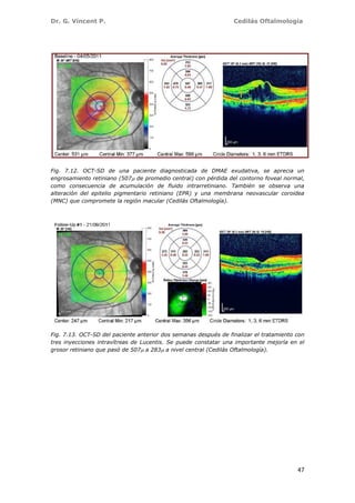 Dr. G. Vincent P. Cedilás Oftalmología
47
Fig. 7.12. OCT-SD de una paciente diagnosticada de DMAE exudativa, se aprecia un
engrosamiento retiniano (507 de promedio central) con pérdida del contorno foveal normal,
como consecuencia de acumulación de fluido intrarretiniano. También se observa una
alteración del epitelio pigmentario retiniano (EPR) y una membrana neovascular coroidea
(MNC) que compromete la región macular (Cedilás Oftalmología).
Fig. 7.13. OCT-SD del paciente anterior dos semanas después de finalizar el tratamiento con
tres inyecciones intravítreas de Lucentis. Se puede constatar una importante mejoría en el
grosor retiniano que pasó de 507 a 283 a nivel central (Cedilás Oftalmología).
 