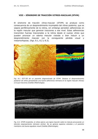 Dr. G. Vincent P. Cedilás Oftalmología
48
VIII – SÍNDROME DE TRACCIÓN VITREO-MACULAR (STVM)
El síndrome de tracción vítreo-macular (STVM) se produce como
consecuencia de un desprendimiento incompleto del vítreo posterior, que se
separa periféricamente de la retina, sin embargo persisten adherencias en
la región macular que generan tracciones a ese nivel. Estas adherencias
transmiten fuerzas traccionales a la retina desde el cuerpo vítreo que
pueden provocar un edema macular cistoide o bien inducir a un
desprendimiento macular con la consiguiente pérdida visual y
metamorfopsias. (figs. 8.1, 8.2 y 8.3).
Fig. 8.1. OCT-SD de un paciente diagnosticado de STVM. Destaca el desprendimiento
posterior de vítreo persistiendo una fuerte adherencia retiniana en la región macular (fóvea)
a la que tracciona (Cedilás Oftalmología).
Fig. 8.2. STVM incipiente, el vítreo ejerce una ligera tracción sobre la mácula provocando un
discreto engrosamiento retiniano central. No se aprecia espacios cistoides y el paciente
mantiene una buena agudeza visual (Cedilás Oftalmología).
 
