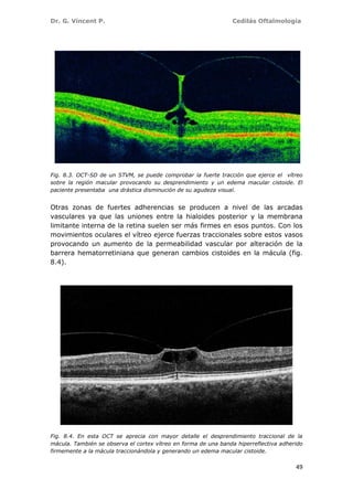 Dr. G. Vincent P. Cedilás Oftalmología
49
Fig. 8.3. OCT-SD de un STVM, se puede comprobar la fuerte tracción que ejerce el vítreo
sobre la región macular provocando su desprendimiento y un edema macular cistoide. El
paciente presentaba una drástica disminución de su agudeza visual.
Otras zonas de fuertes adherencias se producen a nivel de las arcadas
vasculares ya que las uniones entre la hialoides posterior y la membrana
limitante interna de la retina suelen ser más firmes en esos puntos. Con los
movimientos oculares el vítreo ejerce fuerzas traccionales sobre estos vasos
provocando un aumento de la permeabilidad vascular por alteración de la
barrera hematorretiniana que generan cambios cistoides en la mácula (fig.
8.4).
Fig. 8.4. En esta OCT se aprecia con mayor detalle el desprendimiento traccional de la
mácula. También se observa el cortex vítreo en forma de una banda hiperreflectiva adherido
firmemente a la mácula traccionándola y generando un edema macular cistoide.
 