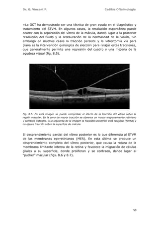 Dr. G. Vincent P. Cedilás Oftalmología
50
+La OCT ha demostrado ser una técnica de gran ayuda en el diagnóstico y
tratamiento del STVM. En algunos casos, la resolución espontánea puede
ocurrir con la separación del vítreo de la mácula, dando lugar a la posterior
resolución del fluido y la restauración de la normalidad de la visión. Sin
embargo en muchos casos la tracción persiste y la vitrectomía vía pars
plana es la intervención quirúrgica de elección para relajar estas tracciones,
que generalmente permite una regresión del cuadro y una mejoría de la
agudeza visual (fig. 8.5).
Fig. 8.5. En esta imagen se puede comprobar el efecto de la tracción del vítreo sobre la
región macular. En la zona de mayor tracción se observa un mayor engrosamiento retiniano
y cambios cistoides. A la izquierda de la imagen la hialoides posterior está relajada (flecha) y
no ejerce tracción sobre la superficie de mácula.
El desprendimiento parcial del vítreo posterior es lo que diferencia al STVM
de las membranas epirretinianas (MER). En esta última se produce un
desprendimiento completo del vítreo posterior, que causa la rotura de la
membrana limitante interna de la retina y favorece la migración de células
gliales a su superficie, donde proliferan y se contraen, dando lugar al
“pucker” macular (figs. 8.6 y 8.7).
 