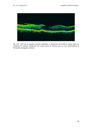 Dr. G. Vincent P. Cedilás Oftalmología
52
Fig. 8.8. OCT de un agujero macular idiopático. A diferencia del STVM en estos casos se
evidencia la tracción tangencial del vítreo sobre la mácula que se cree desencadena la
formación del agujero macular.
 