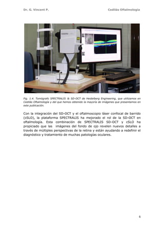 Dr. G. Vincent P. Cedilás Oftalmología
6
Fig. 1.4. Tomógrafo SPECTRALIS ® SD-OCT de Heidelberg Engineering, que utilizamos en
Cedilás Oftalmología y del que hemos obtenido la mayoría de imágenes que presentamos en
este publicación.
Con la integración del SD-OCT y el oftalmoscopio láser confocal de barrido
(cSLO), la plataforma SPECTRALIS ha mejorado el rol de la SD-OCT en
oftalmología. Esta combinación de SPECTRALIS SD-OCT y cSLO ha
propiciado que las imágenes del fondo de ojo revelen nuevos detalles a
través de múltiples perspectivas de la retina y están ayudando a redefinir el
diagnóstico y tratamiento de muchas patologías oculares.
 