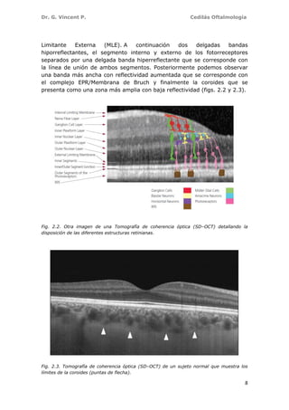 Dr. G. Vincent P. Cedilás Oftalmología
8
Limitante Externa (MLE). A continuación dos delgadas bandas
hiporreflectantes, el segmento interno y externo de los fotorreceptores
separados por una delgada banda hiperreflectante que se corresponde con
la línea de unión de ambos segmentos. Posteriormente podemos observar
una banda más ancha con reflectividad aumentada que se corresponde con
el complejo EPR/Membrana de Bruch y finalmente la coroides que se
presenta como una zona más amplia con baja reflectividad (figs. 2.2 y 2.3).
Fig. 2.2. Otra imagen de una Tomografía de coherencia óptica (SD–OCT) detallando la
disposición de las diferentes estructuras retinianas.
Fig. 2.3. Tomografía de coherencia óptica (SD–OCT) de un sujeto normal que muestra los
límites de la coroides (puntas de flecha).
 