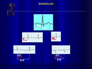 QTi QTi
R-R
R-R
QTi
PRi
INTERVALOS
 