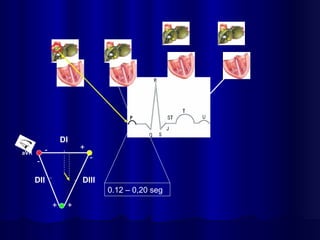 DI
DII DIII
-
+
+
-
+
-
aVR
0.12 – 0,20 seg
 