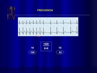 FRECUENCIA
1500
R-R
10 18
83
150
 