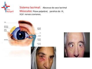 Sistema lacrimal: Abscesso do saco lacrimal
Músculos: Ptose palpebral, paralisia do III,
IV,VI nervos cranianos.

 