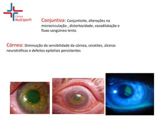 Conjuntiva: Conjuntivite, alterações na
microcirculação , distortocidade, vasodilatação e
fluxo sangüíneo lento.

Córnea: Diminuição da sensibilidade da córnea, ceratites, úlceras
neurotróficas e defeitos epiteliais persistentes

 